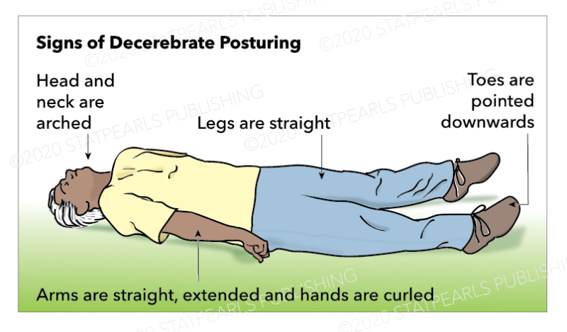 Illustration showing a person lying on the ground with signs of decerebrating posturing