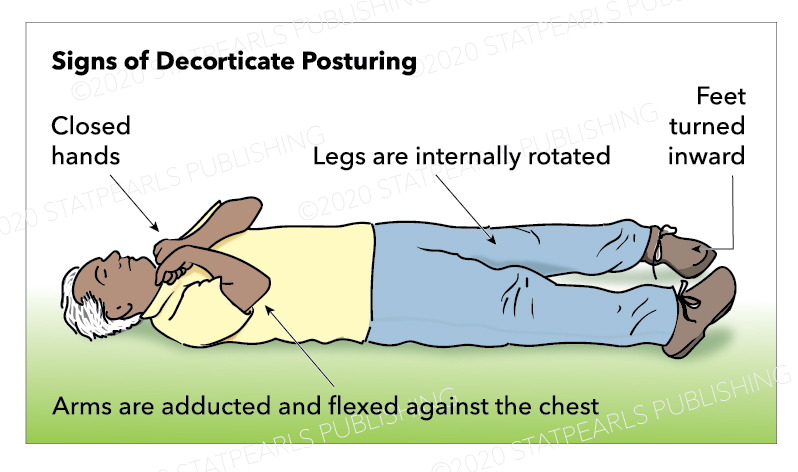 Illustration showing a person laying on the ground with signs of decorticate posturing