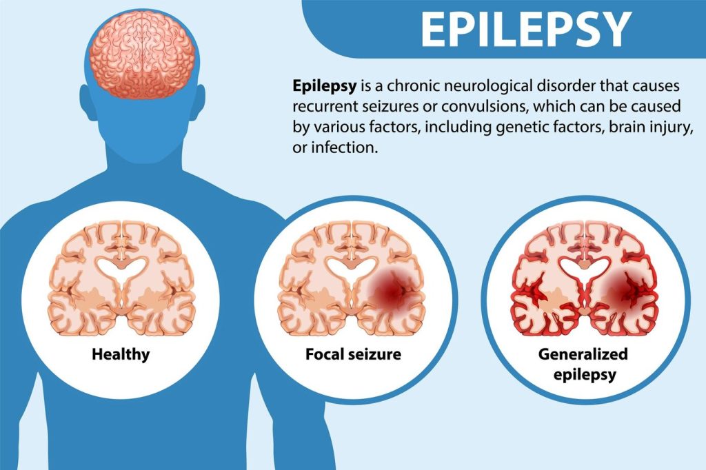 Infographic showing a definition of epilepsy, a human head and torso, and three different brains in circles