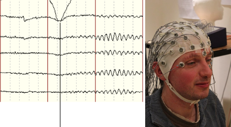 Image showing Electrode Placement on a patient's head and face along with a EEG Waveform