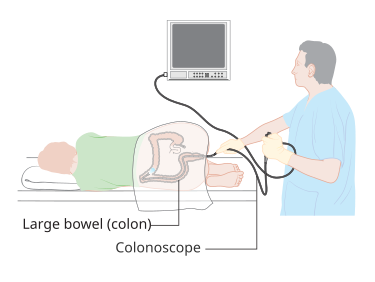 Illustration showing a colonoscopy procedure