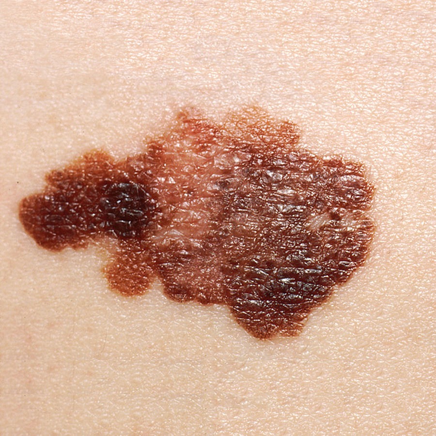 Photo showing melanoma on the skin