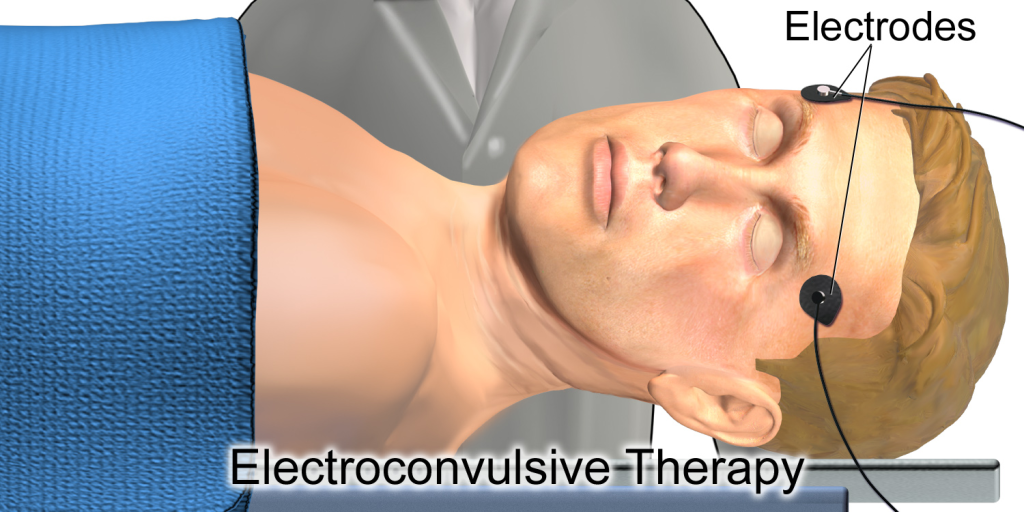 Image showing electrode placement for electroconvulsive therapy