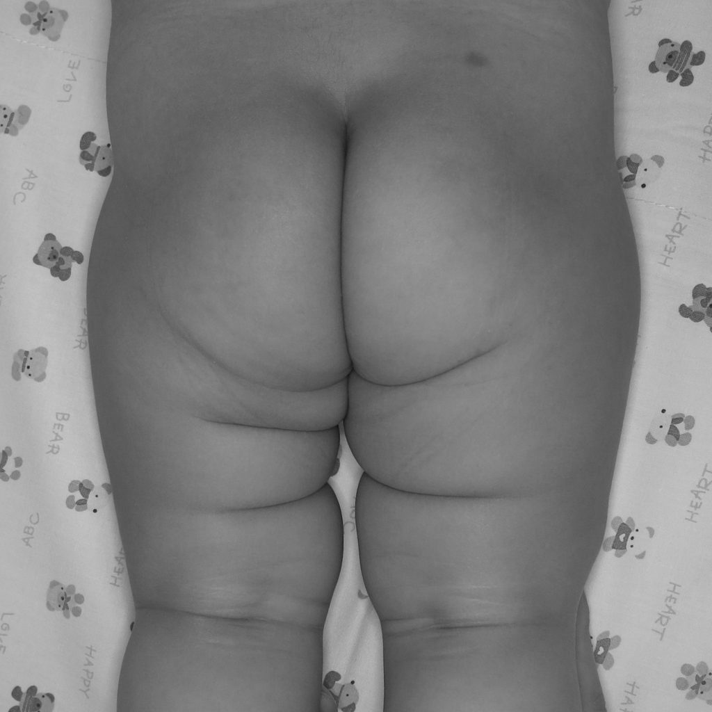 Photo showing uneven gluteal folds on an infant, indicating possible hip dysplasia