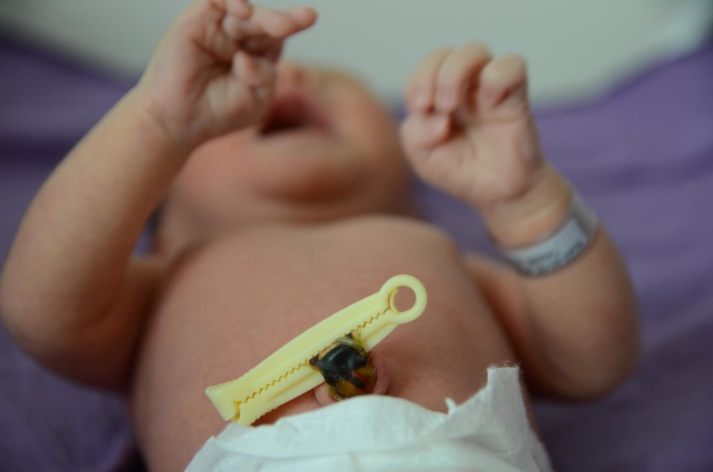 Photo showing a closeup of a clamped umbilical stump on a newborn