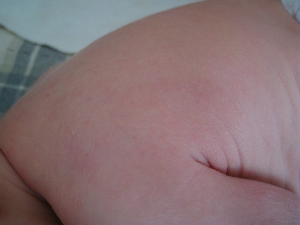 Photo showing lanugo on an infant's back, shoulders, and arms