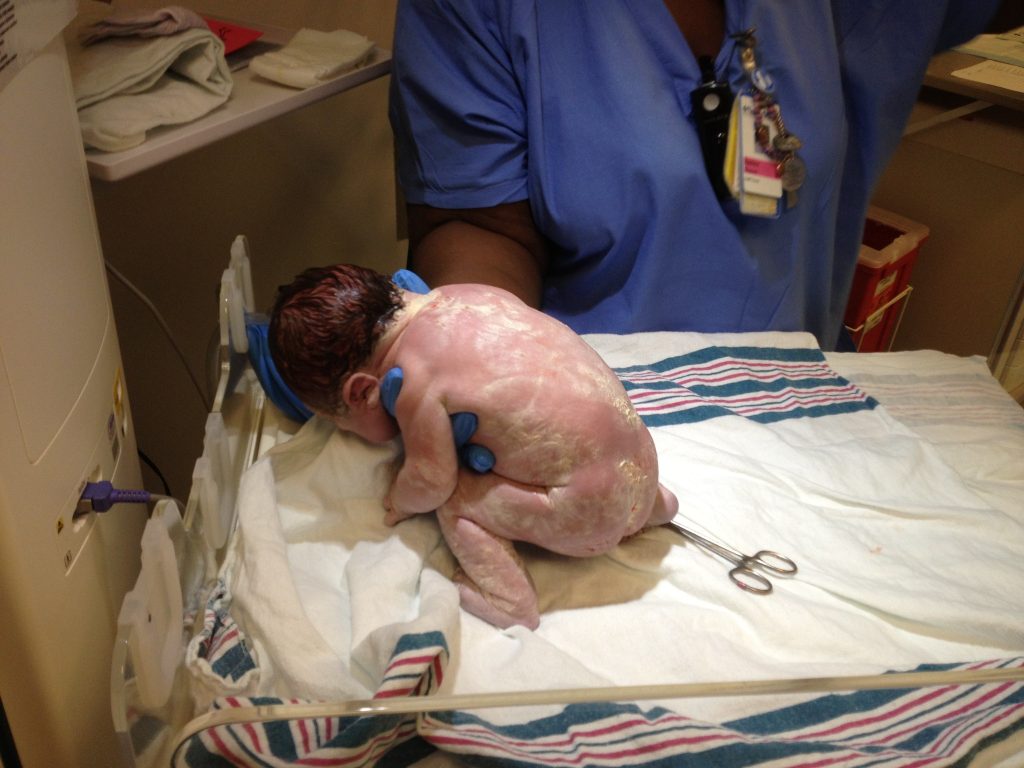 Photo showing a newborn covered in vernix caseosa