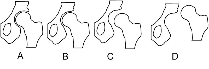 Illustration showing types of misalignments of the femoral head to the acetabulum in hip dysplasia