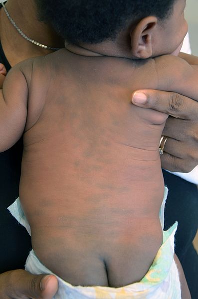 Photo showing an infant's back, covered in Congenital dermal melanocytosis