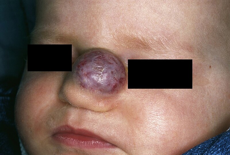 Photo showing an infant with hemangioma on their nose