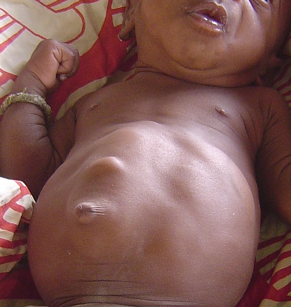 Photo showing a newborn with diastasis recti