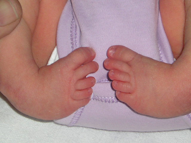 Photo showing a child with clubbed feet