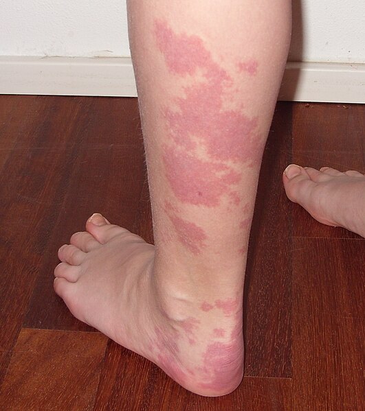 Photo showing a person's leg and foot covered in nevus flammeus