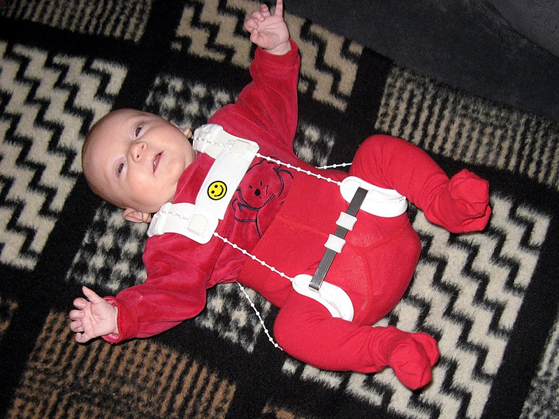 Photo showing an infant in a pavlik harness