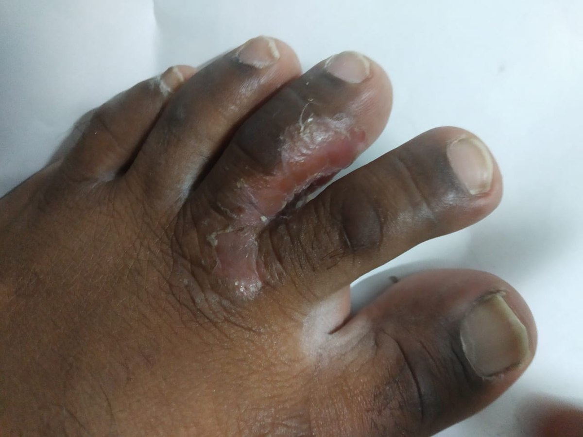 Photo showing tinea pedis