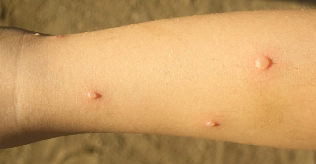 Photo showing blisters caused by varicella