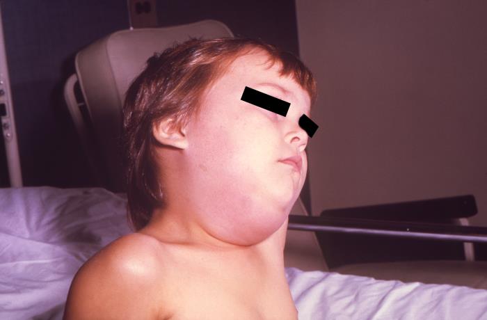 Photo showing a Child with Parotitis Due to Mumps