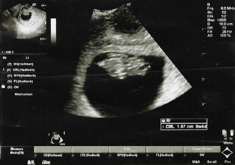 Ultrasound showing fetus during first trimester