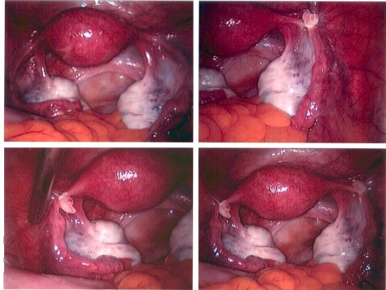 Photos showing the process of tubal ligation