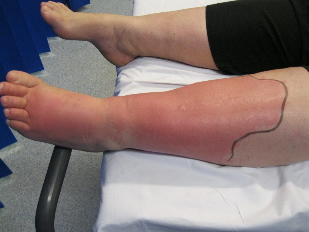 Photo showing cellulitis of the lower leg