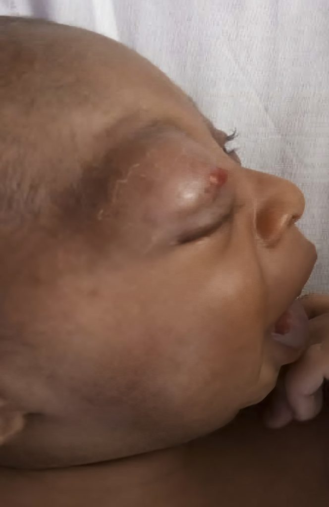 Photo showing an infant with periorbital cellulitis