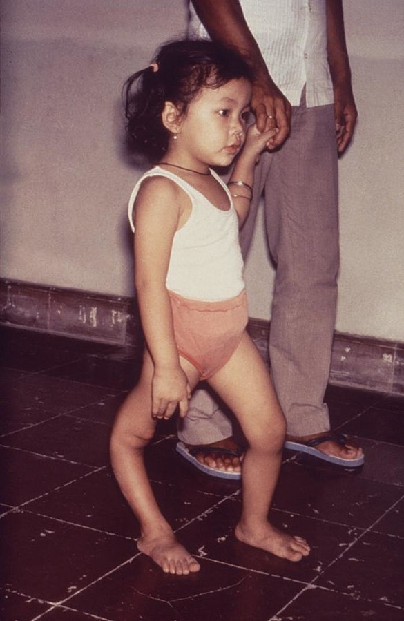 Photo showing a child with a leg deformity as a result of polio infection