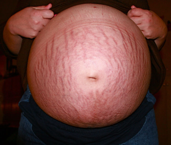 Photo showing striae gravidarum on a pregnant woman's belly