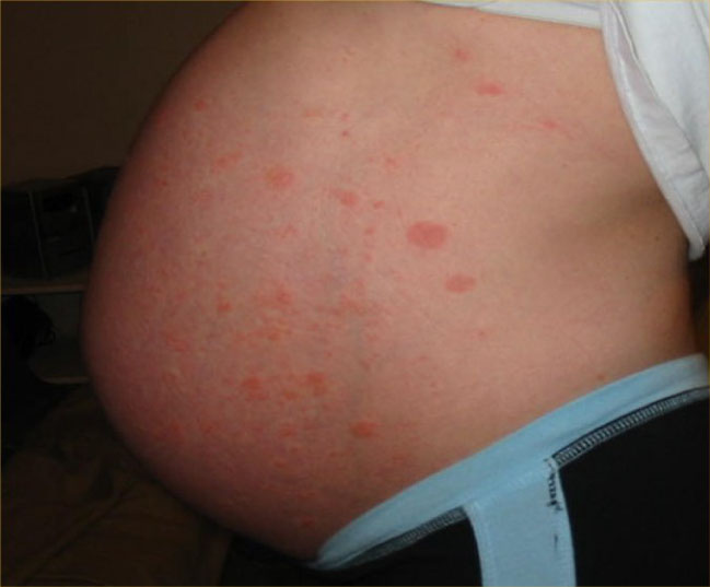 Photo showing a pregnant patient with a PUPPP rash