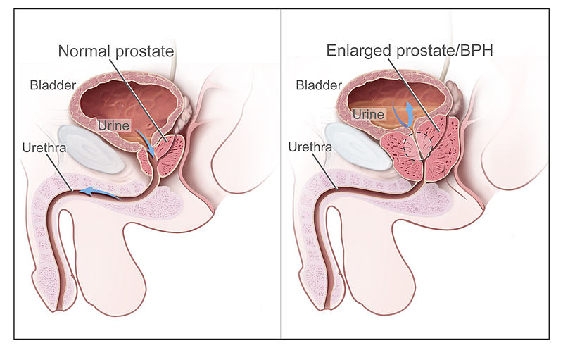 Illustration showing a comparison between a normal prostate and and one that is enlarged due to Benign prostatic hypertrophy