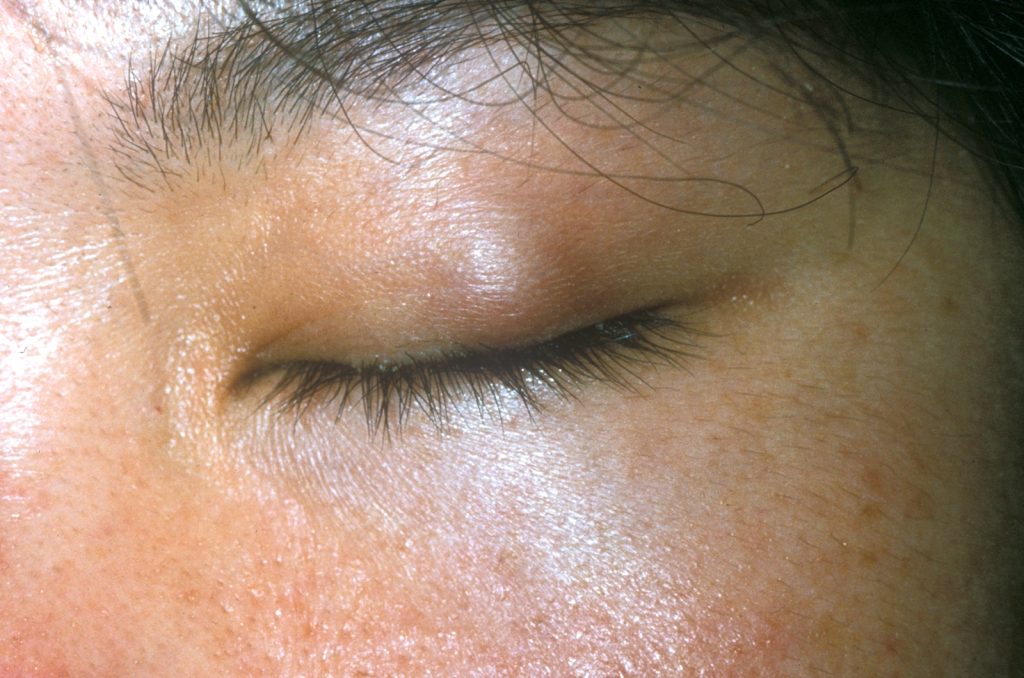 Photo showing a chalazion on the upper eyelid