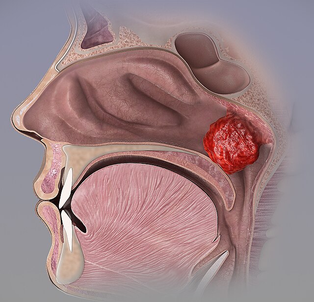 Illustration showing Enlarged adenoids blocking the nasal passage