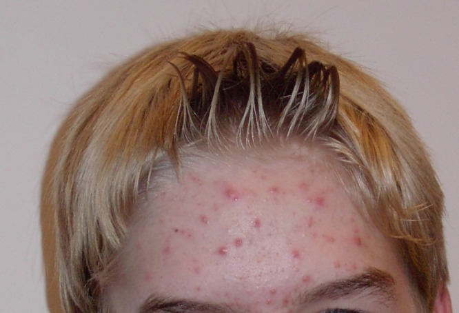 Photo showing acne vulgaris