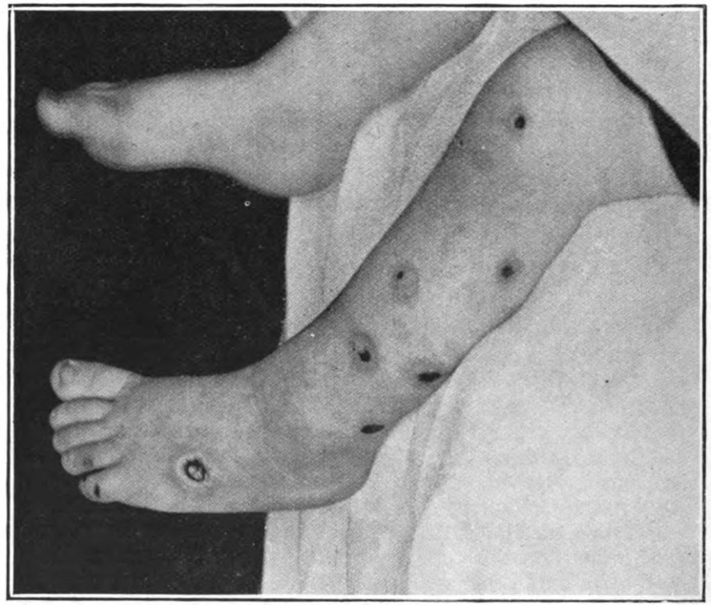 Photo showing deep lesions of ecthyma on a child's leg