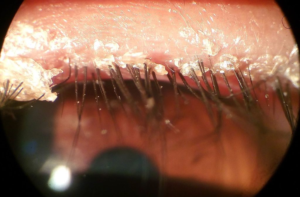 Photo showing Eyelid Crusting From Blepharitis