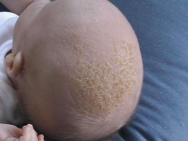 Photo shwoing an infant with cradle cap