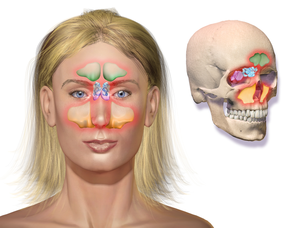 Illustration showing areas impacted by sinusitus