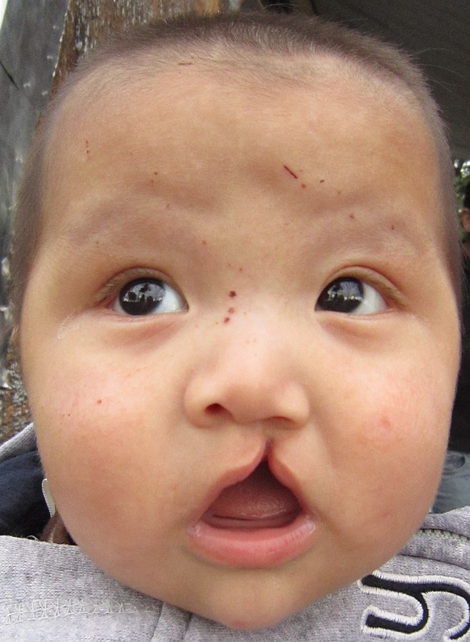 Photo showing a child with a cleft lip