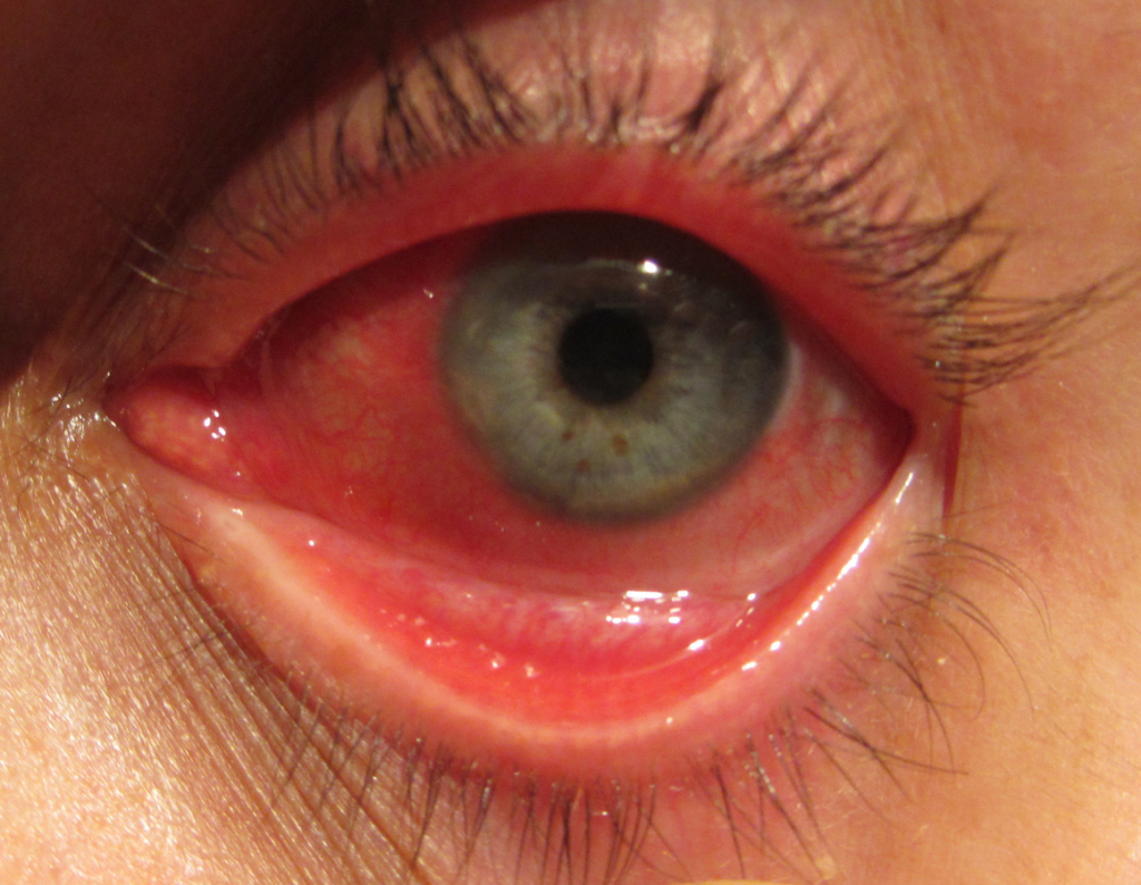 Photo showing an eye that is inflamed from Conjunctivitis