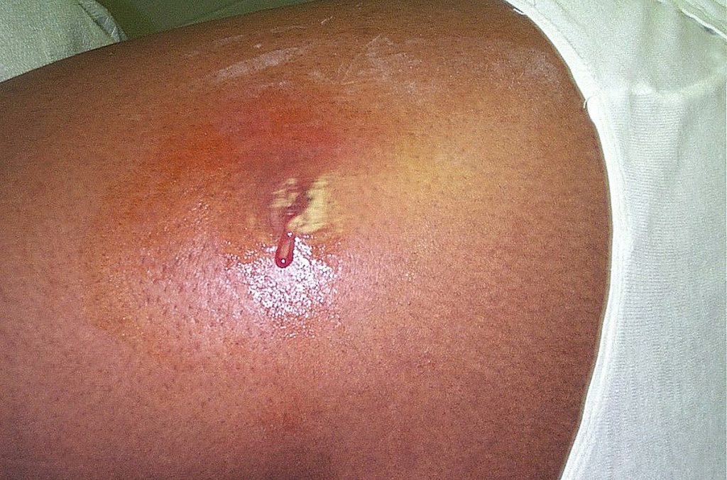 Photo showing a draining abscess caused by MRSA