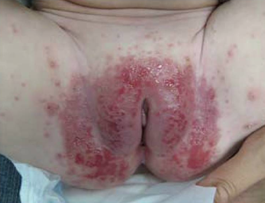 Photo showing a female infant with severe diaper candidiasis