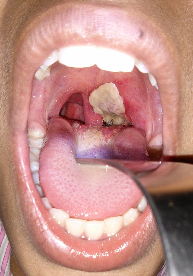 Photo showing Membrane Associated With Diphtheria