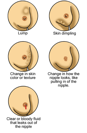 Illustration showing several signs of breast cancer