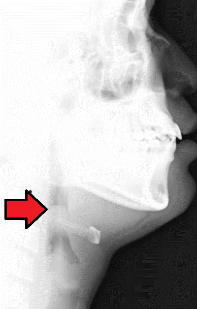 X-ray image showing a swollen epiglottis