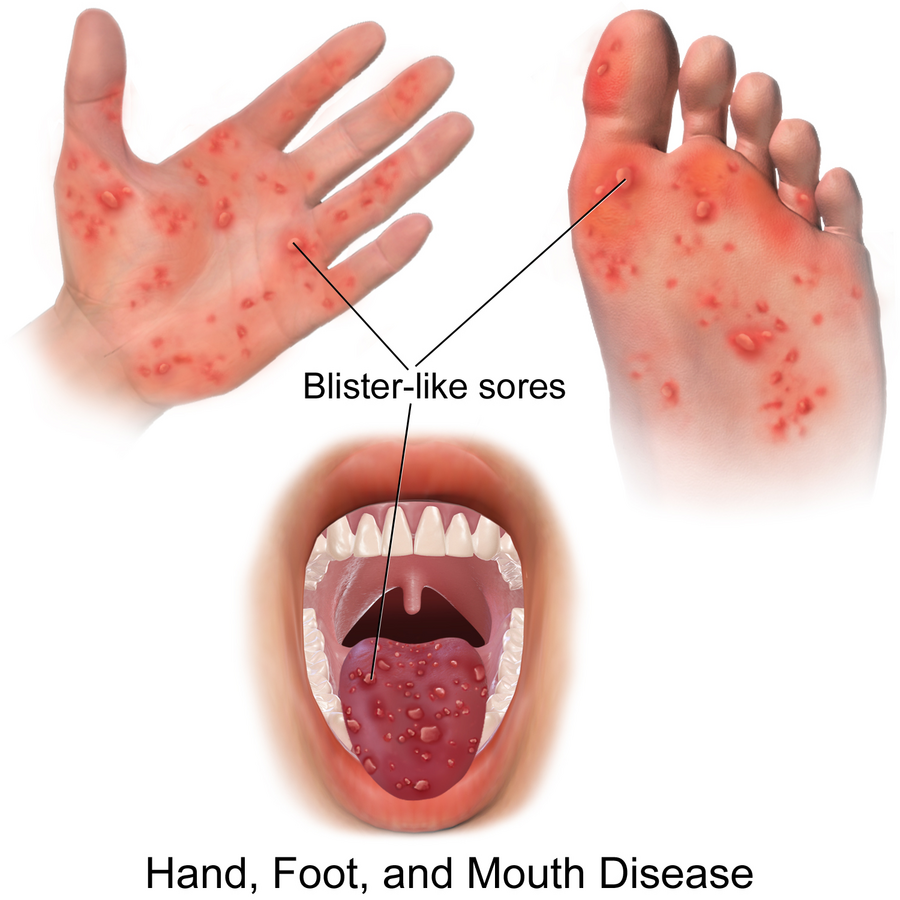 Illustration showing lesions of hand, foot, and mouth disease