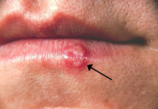 Photo showing a closeup of a mouth ulcer cause by HSV 1