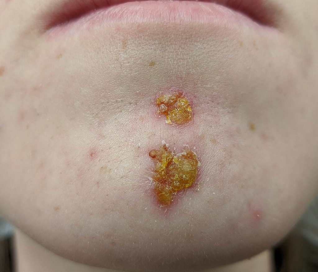 Photo showing Honey-Colored Crust Associated with Nonbullous Impetigo Source