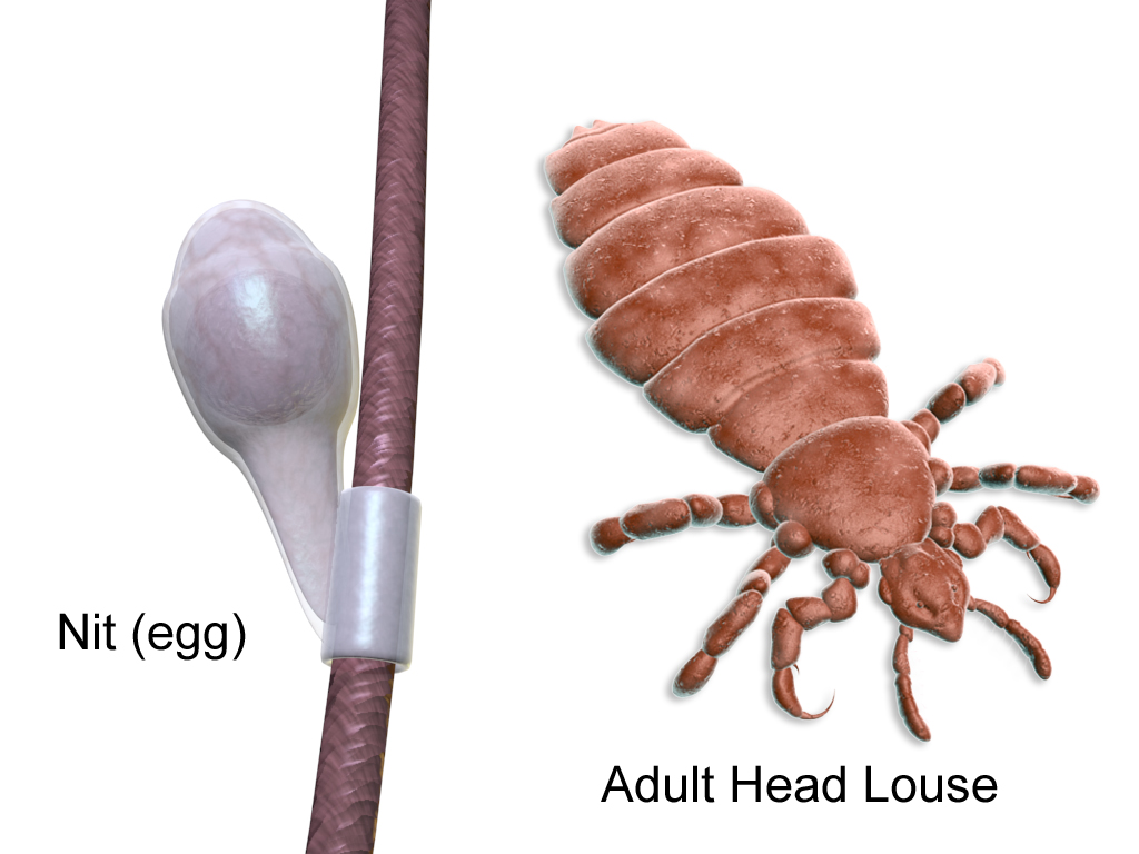 Illustration showing Adult Head Louse and a Nit Wrapped Around a Hair Follicle