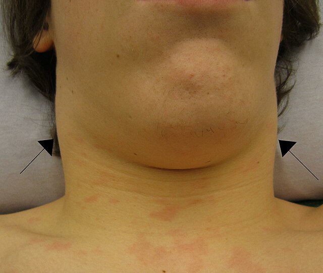 Photo showing a person's Swollen Lymph Nodes Due to Infectious Mononucleosis