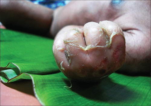 Photo showing skin peeling on an infant with Staphylococcal scalded skin syndrome (SSSS)