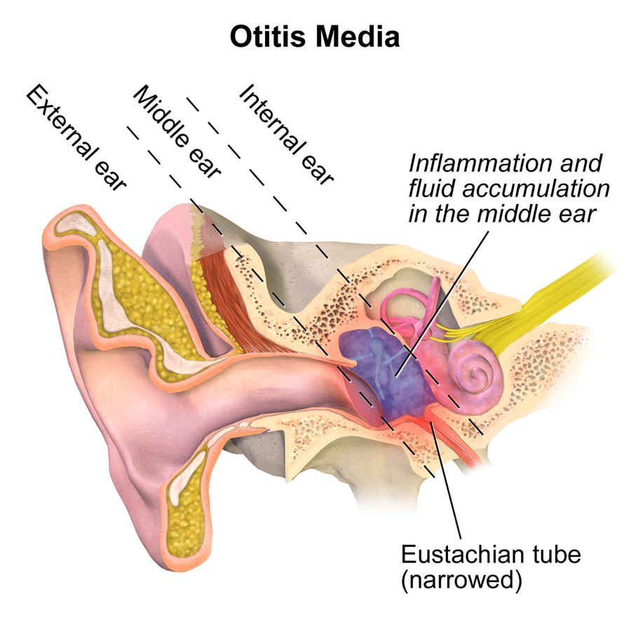 Illustration showing otitis media